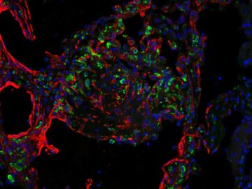 Circulation: Researchers Identify a Key Mechanism Driving Coronary Damage in Kawasaki Disease